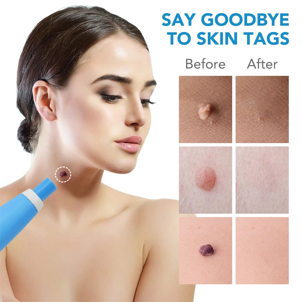 Body Wart Dot Treatments Remover