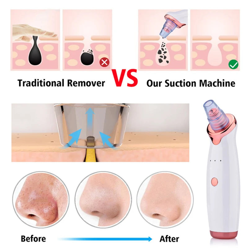 New Electric Facial Blackhead Remover