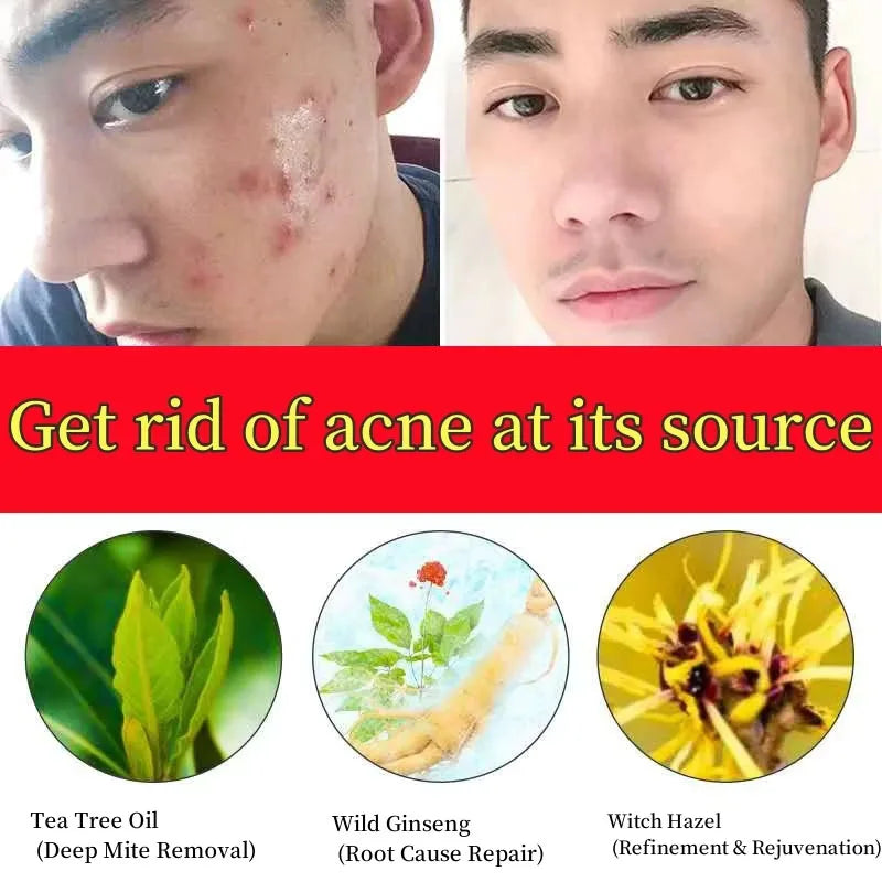 New Salicylic Acid Acne Treatment Cream