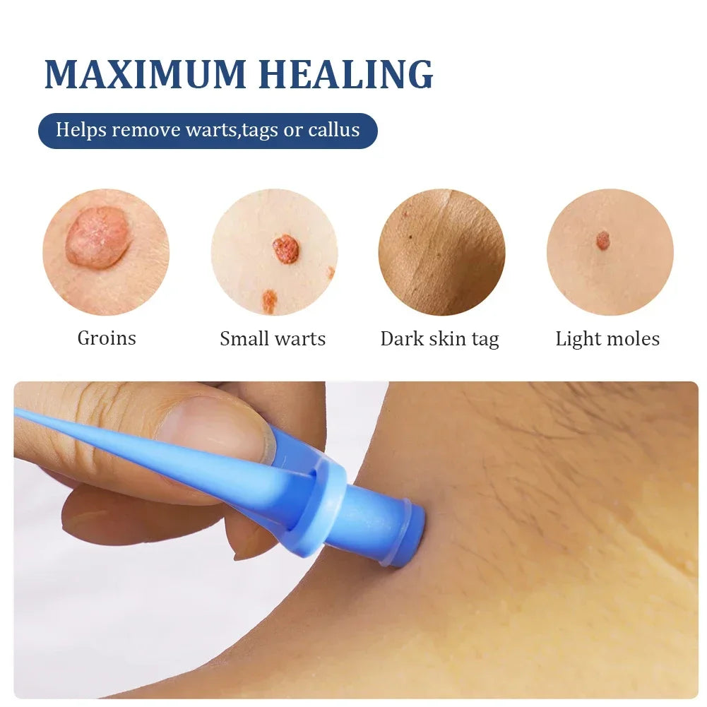 New Skin Care Rubber Bands Skin Tag Remover