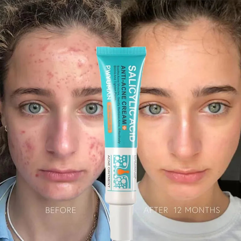 New Salicylic Acid Acne Treatment Cream