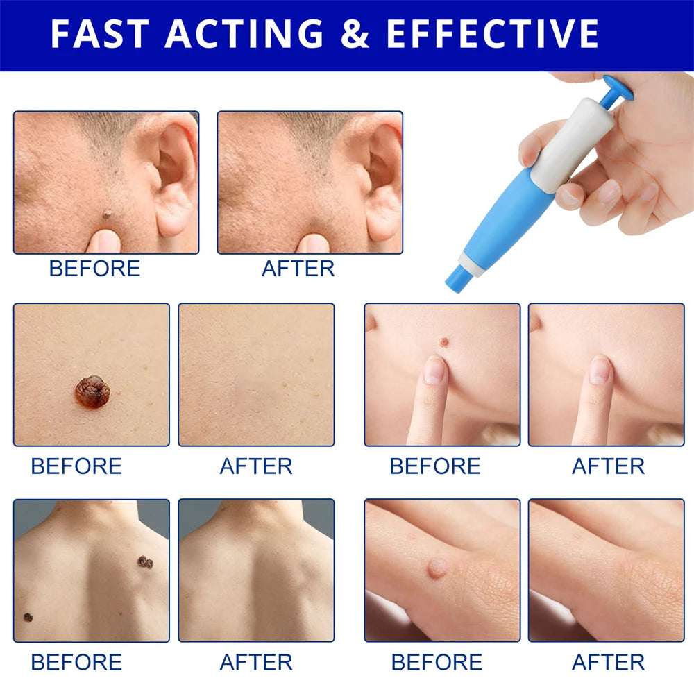 Body Wart Dot Treatments Remover