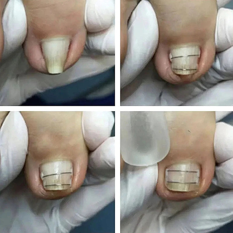 Ingrown Toenail Corrector Tools