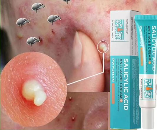 New Salicylic Acid Acne Treatment Cream