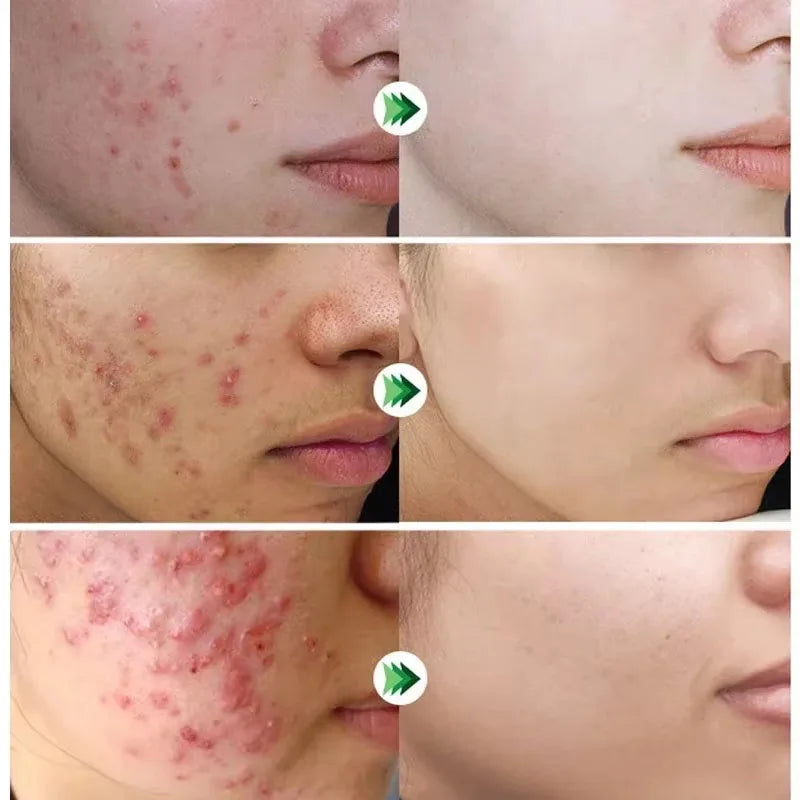 New Salicylic Acid Acne Treatment Cream