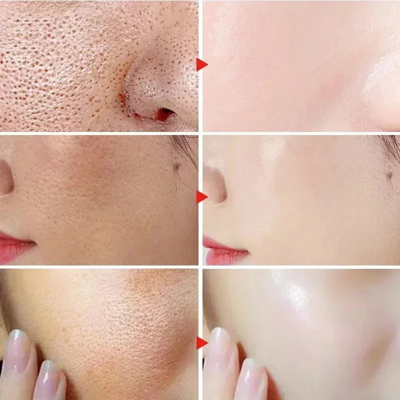 New Salicylic Acid Pore Shrinking Cream