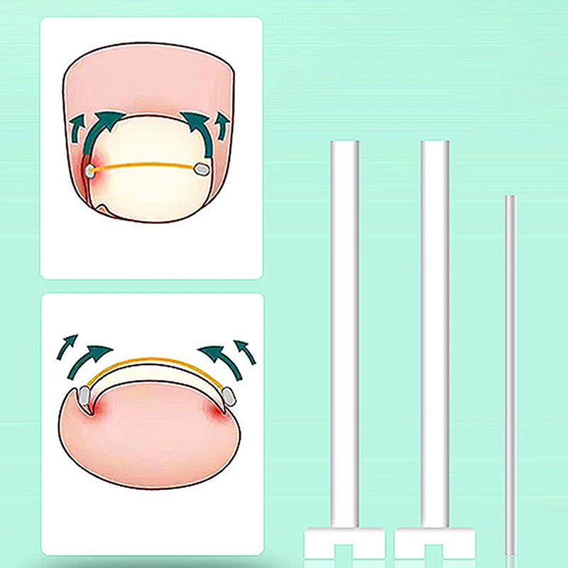 Ingrown Toenail Corrector Tools