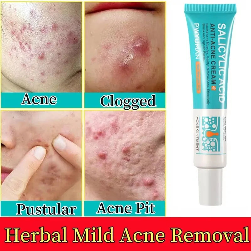 New Salicylic Acid Acne Treatment Cream